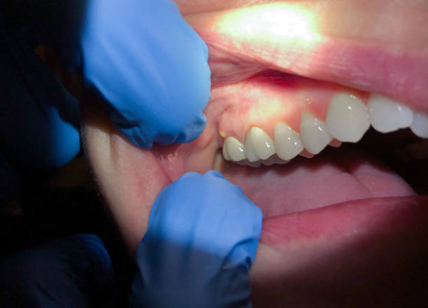Best Emergency Wisdom Teeth Removal in Manchester, IA